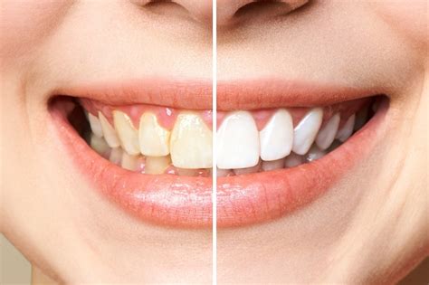 Magic Teeth Whitening: A Safe and Effective Solution
